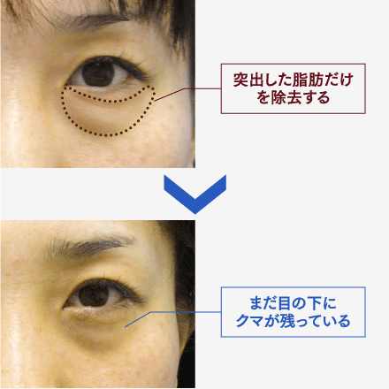 目の下のたるみ・クマ解消のポイントのイメージ