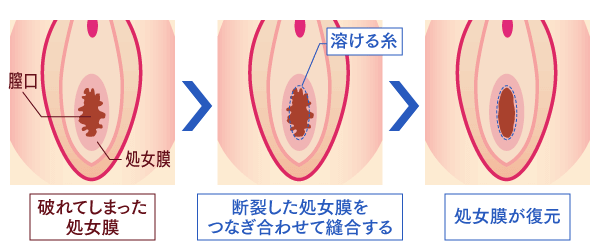 処女膜の再生イメージ