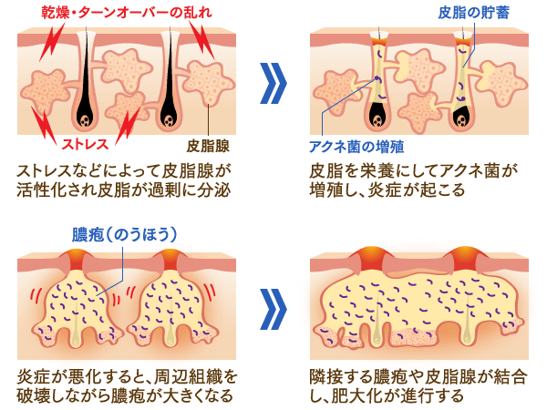 「大人ニキビ」と皮脂腺の関係のイメージ