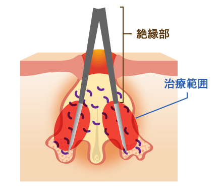 小林式ニキビ治療法イメージ