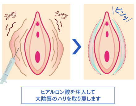 大陰唇のボリュームアップイメージ