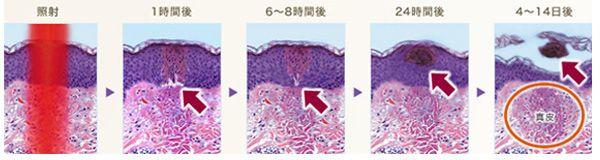 『毛孔性苔癬フラクセル』による肌再生メカニズム