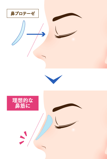 鼻プロテーゼのイメージ