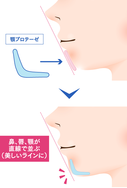 顎プロテーゼ（顎整形）のイメージ