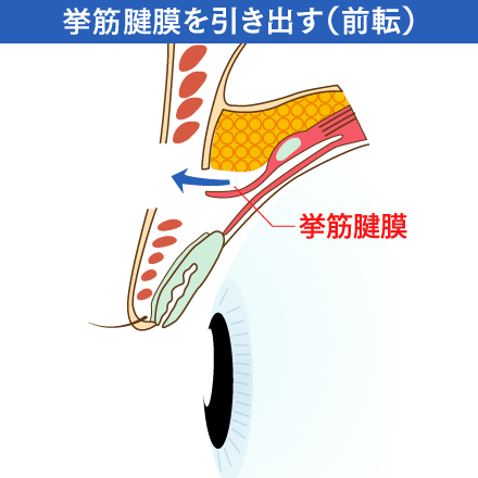 眼瞼下垂の挙筋腱膜を引き出す（前転）イメージ