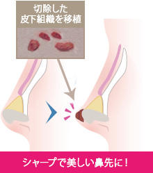 切除組織鼻先移植のイメージ