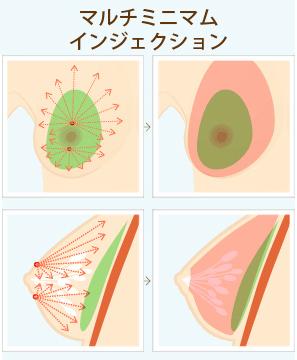 しこり・石灰化のリスク対策