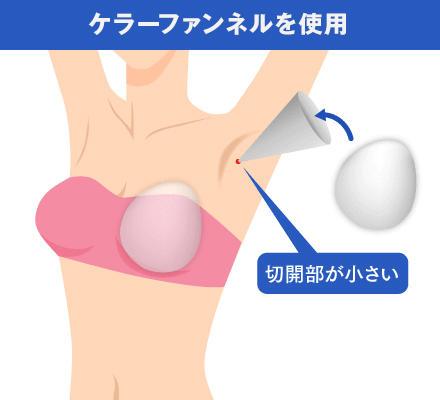 ②傷跡が目立ちにくい方法を採用