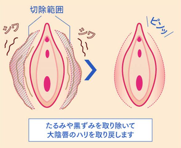 大陰唇縮小術とは