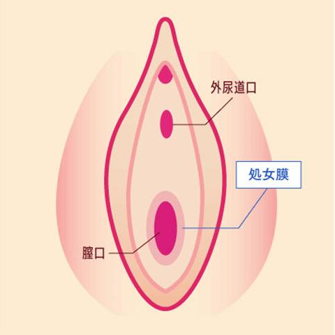 処女膜切開術