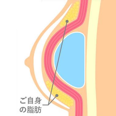 ハイブリッド豊胸