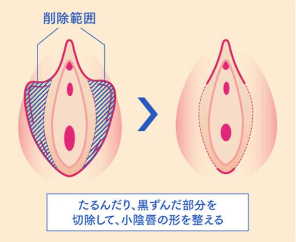 小陰唇にアプローチ「小陰唇縮小術」