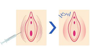 切らずに大陰唇をふっくらさせる「大陰唇増大術」