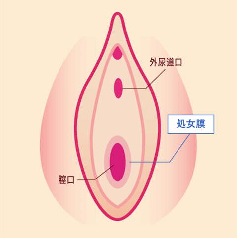 硬い処女膜を切開または切除する「処女膜切開術」