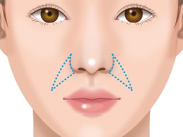 貴族手術（鼻翼基部形成術）とは？