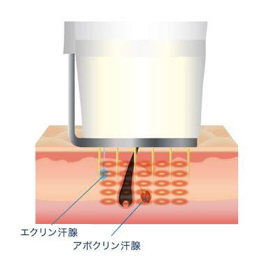 ビューホットでワキガ 多汗症の治療をしよう メリットや注意点を紹介 公式 オザキクリニック