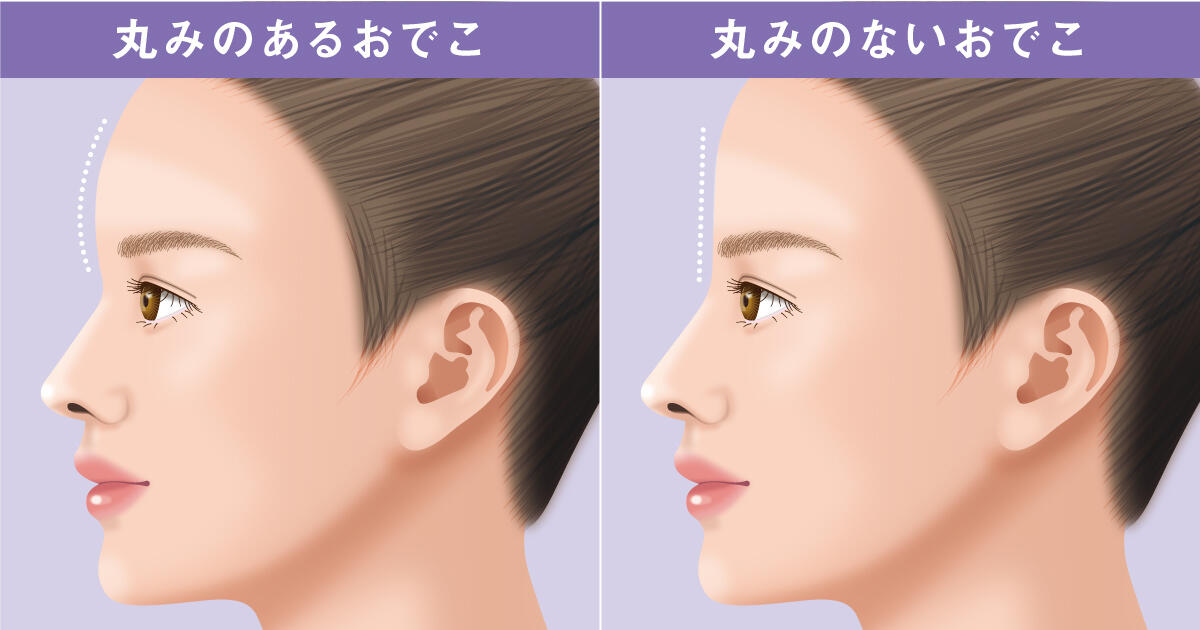 おでこを丸くするならヒアルロン酸注射？脂肪注入？目指せ横顔美人｜【公式】オザキクリニック（新宿・目黒祐天寺・羽村）