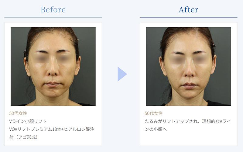 「糸リフト」の改善効果がわかる症例写真