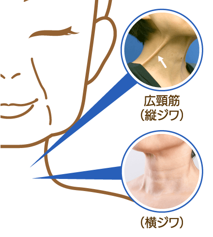 ネックリフトの適応症状