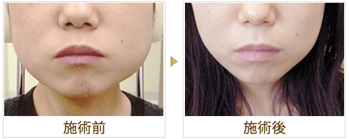 ボトックス（小顔）の症例写真