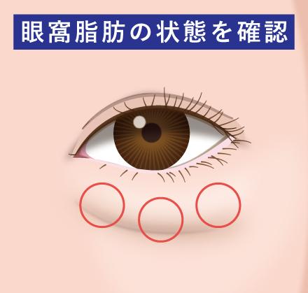 目の下の脱脂3点をしっかり除去
