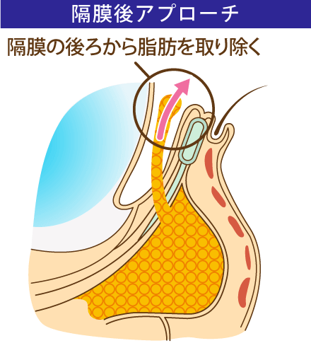 目の下の脱脂の隔膜後アプローチのイメージ