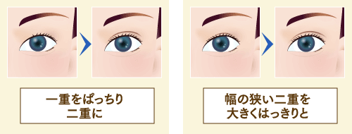 二重埋没法のイメージ