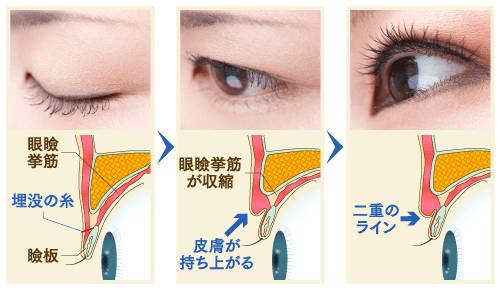 二重埋没法のメカニズムのイメージ
