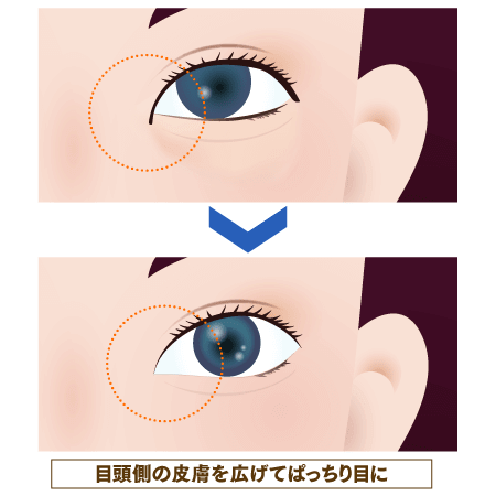 目頭切開のイメージ