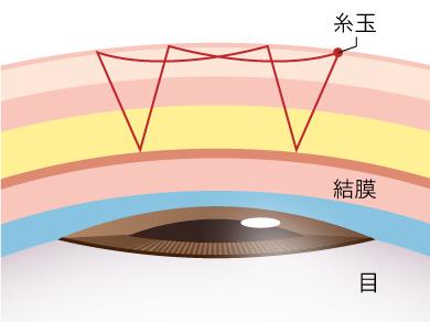 取れにくい二重埋没法「線留め」のメリット