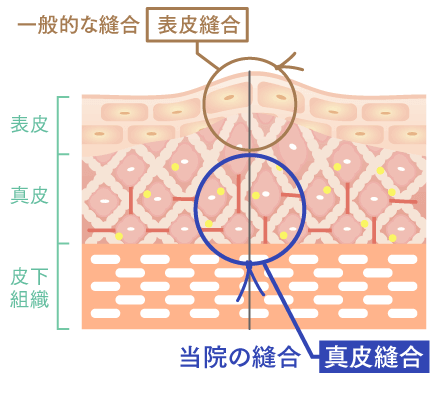 オザキクリニックの真皮縫合のイメージ