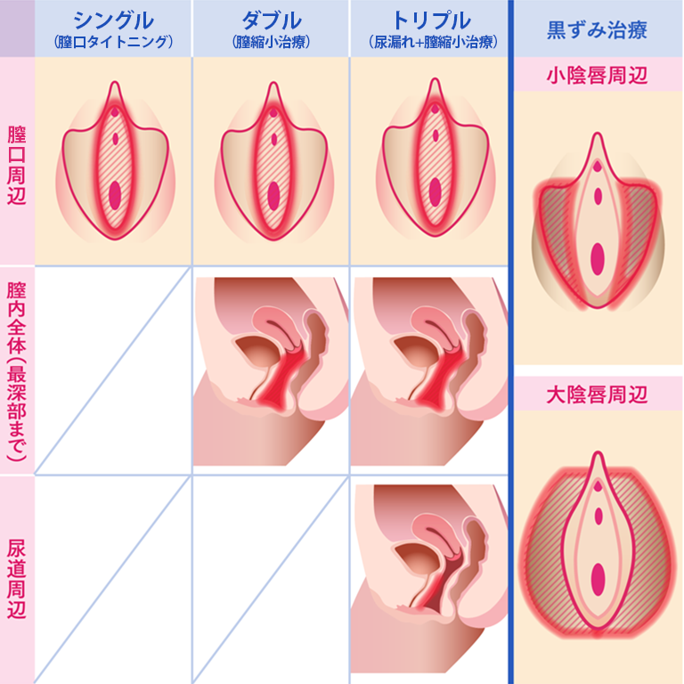 インティマレーザー（尿漏れ・膣縮小・黒ずみ）｜【公式】オザキクリニック（新宿・目黒祐天寺・羽村）