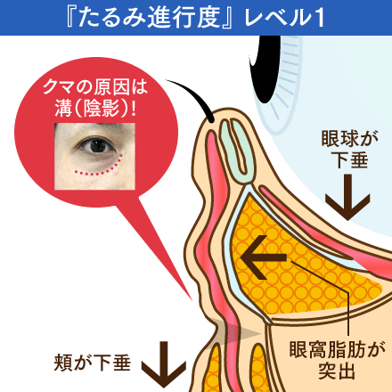 たるみ進行度レベル1のイメージ