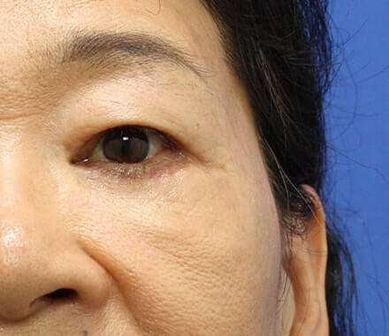 下まぶたのたるみ取りのイメージ