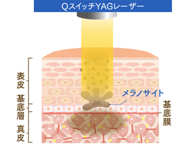 QスイッチYAGレーザーでシミホクロをピンポイント除去｜施術特徴や効果 ...