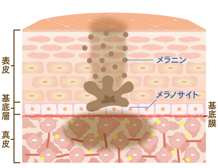 メラニンが蓄積した様子