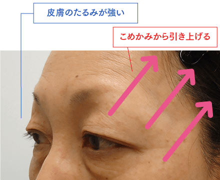 まぶた・こめかみリフトで自然に目元をリフトアップ｜施術の特徴効果解説｜【公式】オザキクリニック（新宿・目黒祐天寺・羽村）