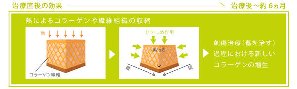 熱によるコラーゲンや線維組織の収縮